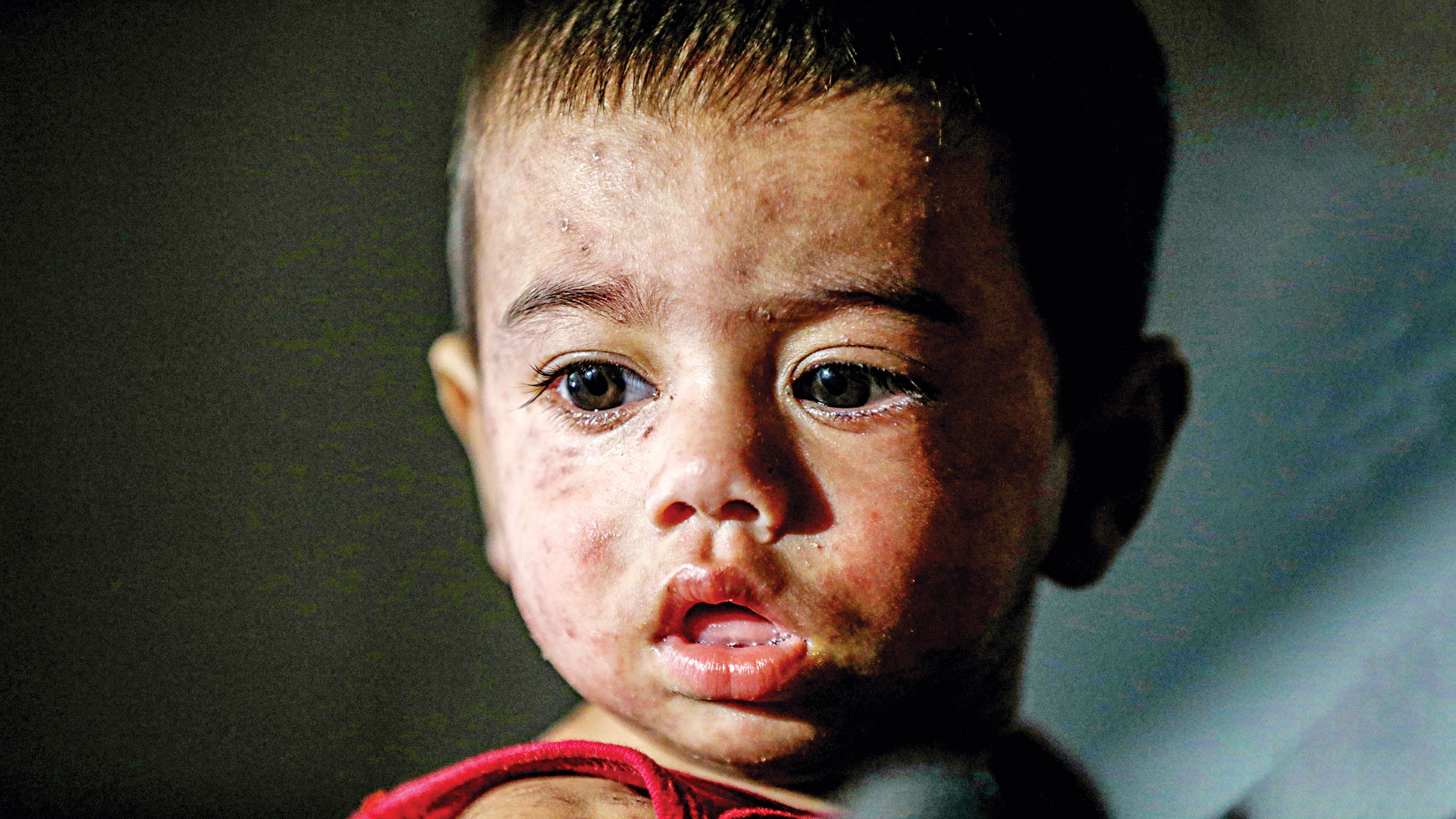 ৫৬ জেলায় ছড়িয়েছে হাম, ২১ উপজেলা উচ্চ ঝুঁকিপূর্ণ