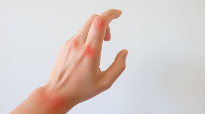 রিউমাটয়েড আর্থ্রাইটিস কেন হয়, লক্ষণ ও চিকিৎসা কী