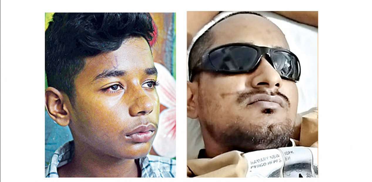 ছাত্র-জনতার আন্দোলনে অন্তত ৫৫০ জন এক চোখ, কিংবা দুই চোখই হারিয়েছেন