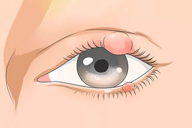 চোখে অঞ্জনি হলে কী করবেন &nbsp;&nbsp;