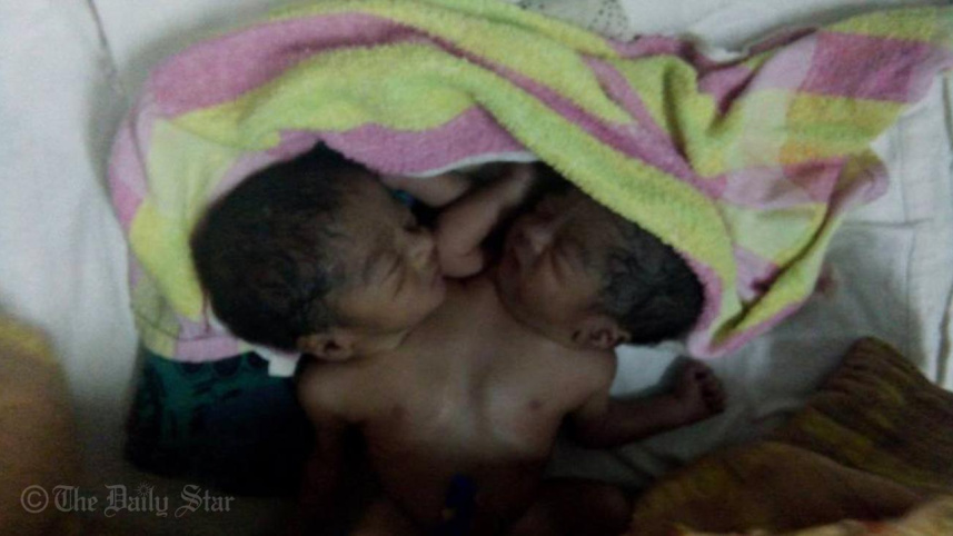 ঢাকা মেডিকেলের পেডিয়াট্রিক সার্জারি ইউনিটে রেখে যাওয়া দুই শিশু। ছবি: শাহীন মোল্লা