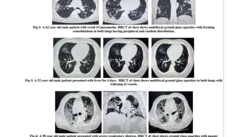 মৌলভীবাজার করোনা রোগী শনাক্তে আরটি পিসিআর এর চেয়ে সিটি স্ক্যান সংবেদনশীলতা বেশি pic.jpg