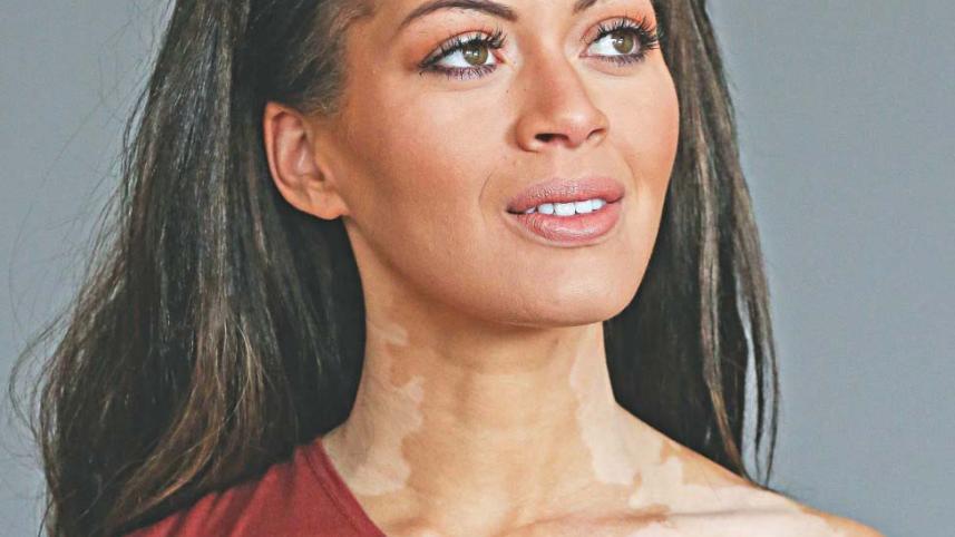 vitiligo-11.jpg