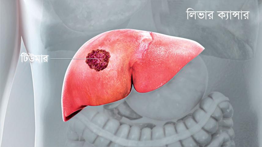 liver-cancer.jpg