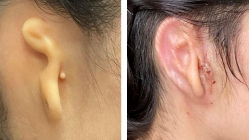 alexas-ear-before-the-transplant-left-and-the-results-30-days-after-the-procedure-right.-pic-microtia-congenital-ear-institute-and-3dbio-therapeutics.jpeg