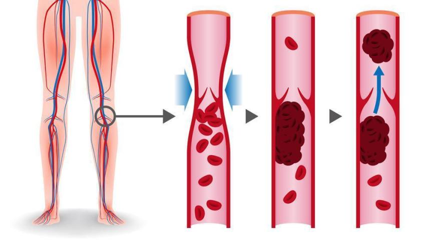 ডিভিটি বা শিরায় রক্ত জমাট বাঁধা