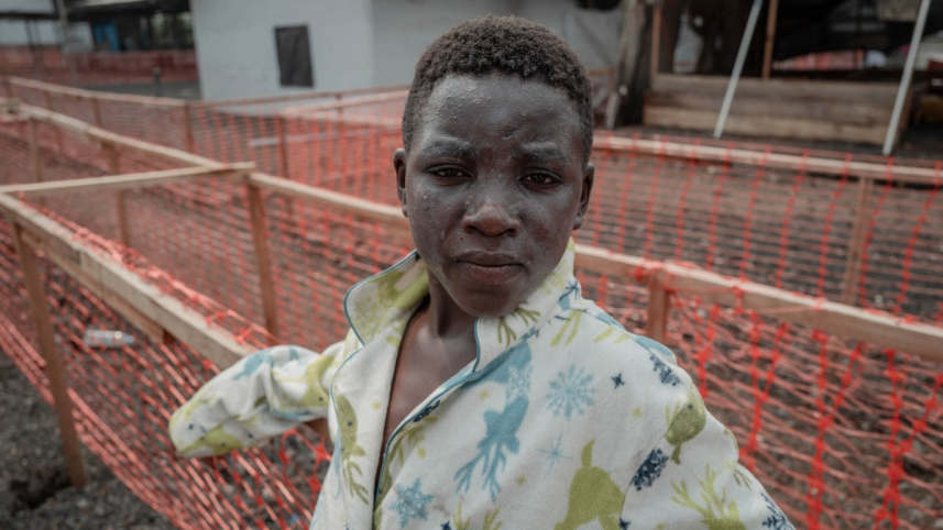 কঙ্গোর নাগরিক প্রিন্স বাহাতি এমপক্সে আক্রান্ত হয়ে নিরাগঙ্গো জেনারেল রেফারেন্স হাসপাতালে চিকিৎসা নিচ্ছেন। ছবি: এএফপি (১৭ আগস্ট, ২০২৪)