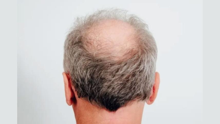 চুল পড়া.jpeg