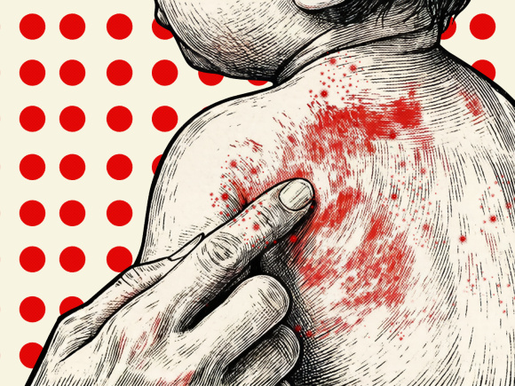 Measles
