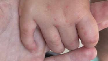 হ্যান্ড ফুট অ্যান্ড মাউথ ডিজিজ