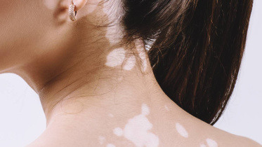 শ্বেতীর চিকিৎসা