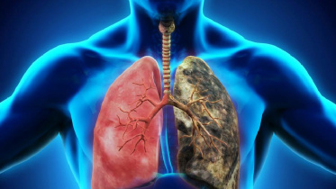 ফুসফুসের ক্যানসার
