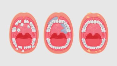 মুখের ক্যানসার