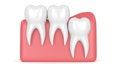 আক্কেল দাঁত