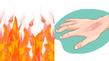 ত্বক পুড়ে গেলে করণীয়