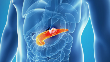 অগ্ন্যাশয়ের ক্যানসার 