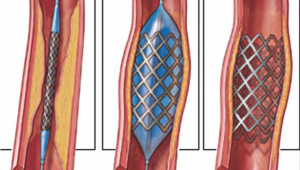 হার্টের চিকিৎসা: স্টেন্টের দাম বৃদ্ধিতে রোগীর ওপর বাড়তি চাপ