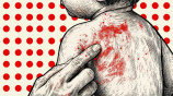 Measles